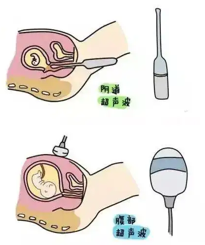 北京助孕机构包生女孩 北京供精试管婴儿流程： ‘9个怀女孩征兆’